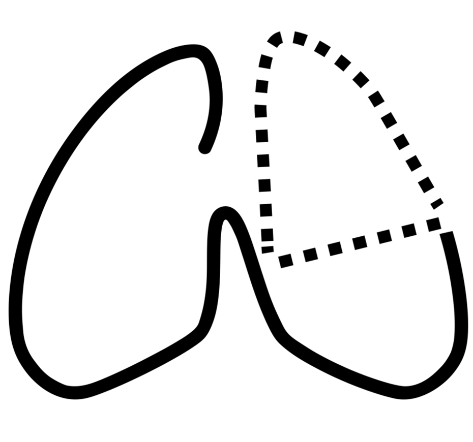 Lobectomia pulmonar