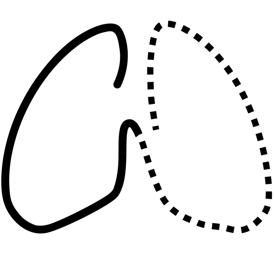 Pneumonectomia