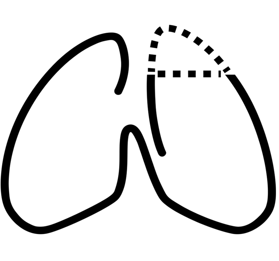 Segmentectomia