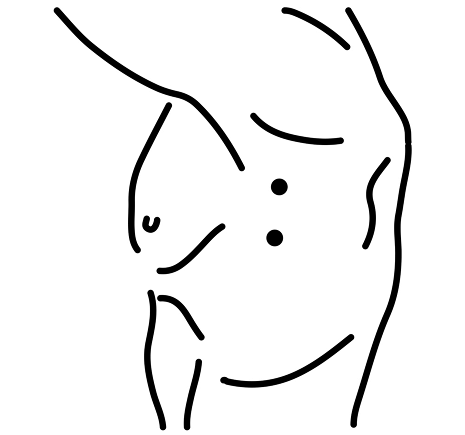Simpatectomia