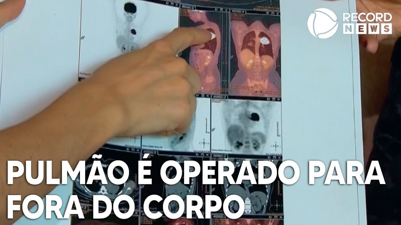 Brasileiro tem pulmão direito operado para fora do corpo