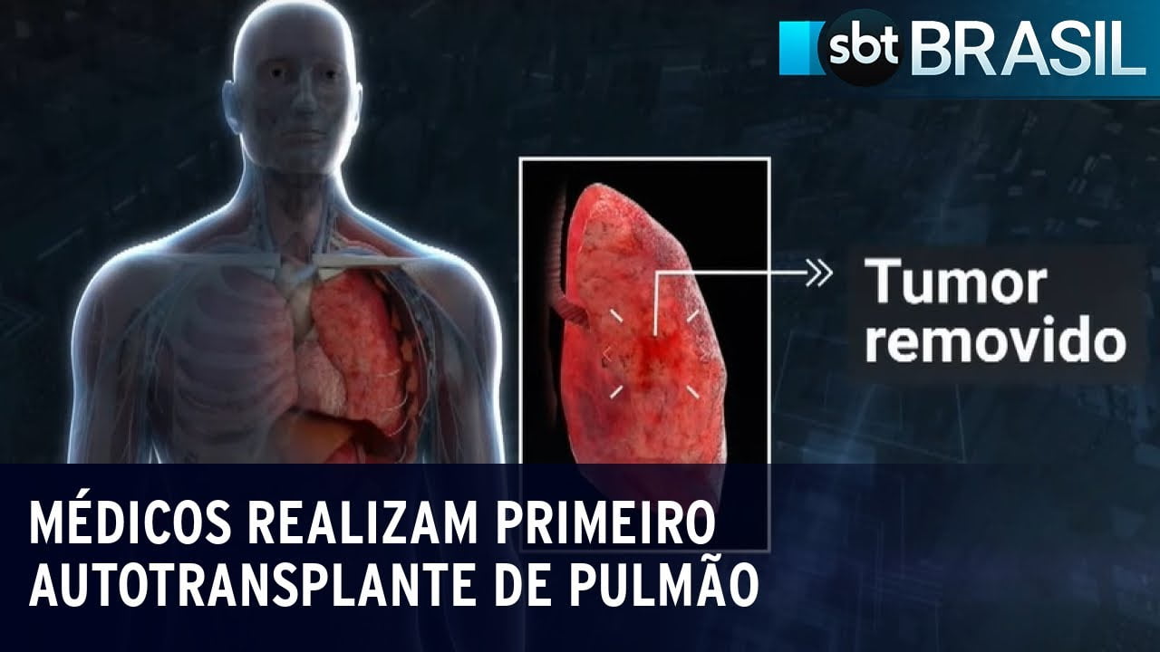 Médicos realizam primeiro autotransplante de pulmão em São Paulo | SBT Brasil