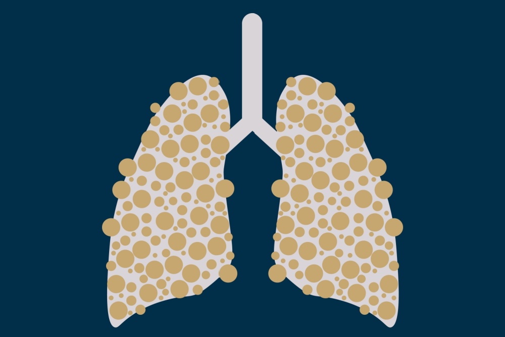 Bolhas pulmonares: causas, sintomas e como tratar