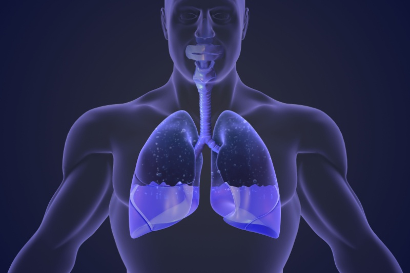 O que é derrame pleural?