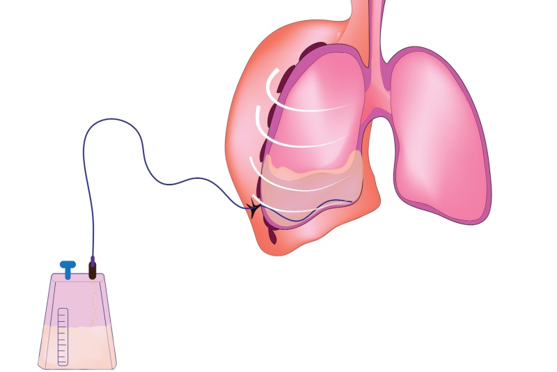 Pleurodese: tudo sobre a técnica e suas indicações