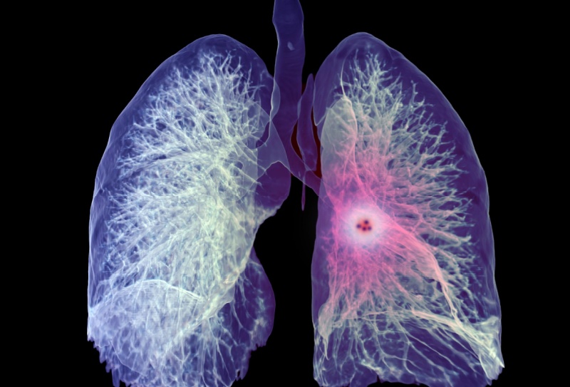 Remoção de nódulo pulmonar: quando é necessária e como é feita