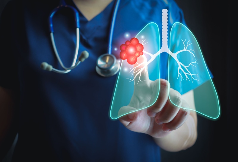 Tratamento de metástase pulmonar
