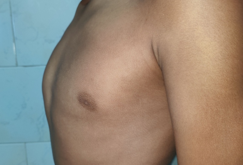 Pectus carinatum: o que é, sintomas e opções de tratamento