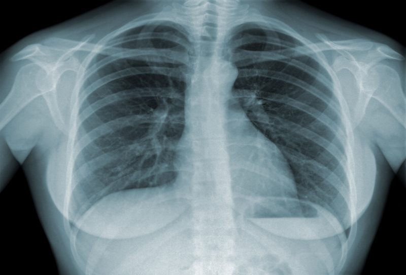 Derrame pleural é grave?