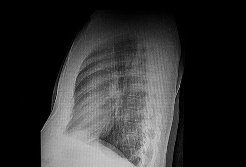 Como funciona a cirurgia de pectus excavatum?