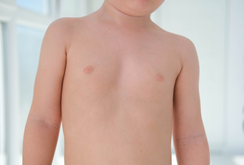 Como tratar pectus excavatum?